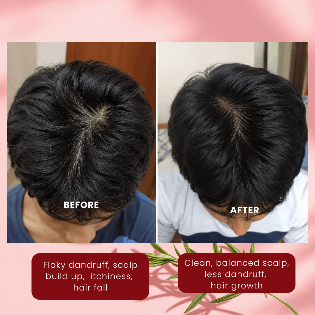 Anti-Dandruff Scalp Concentrate