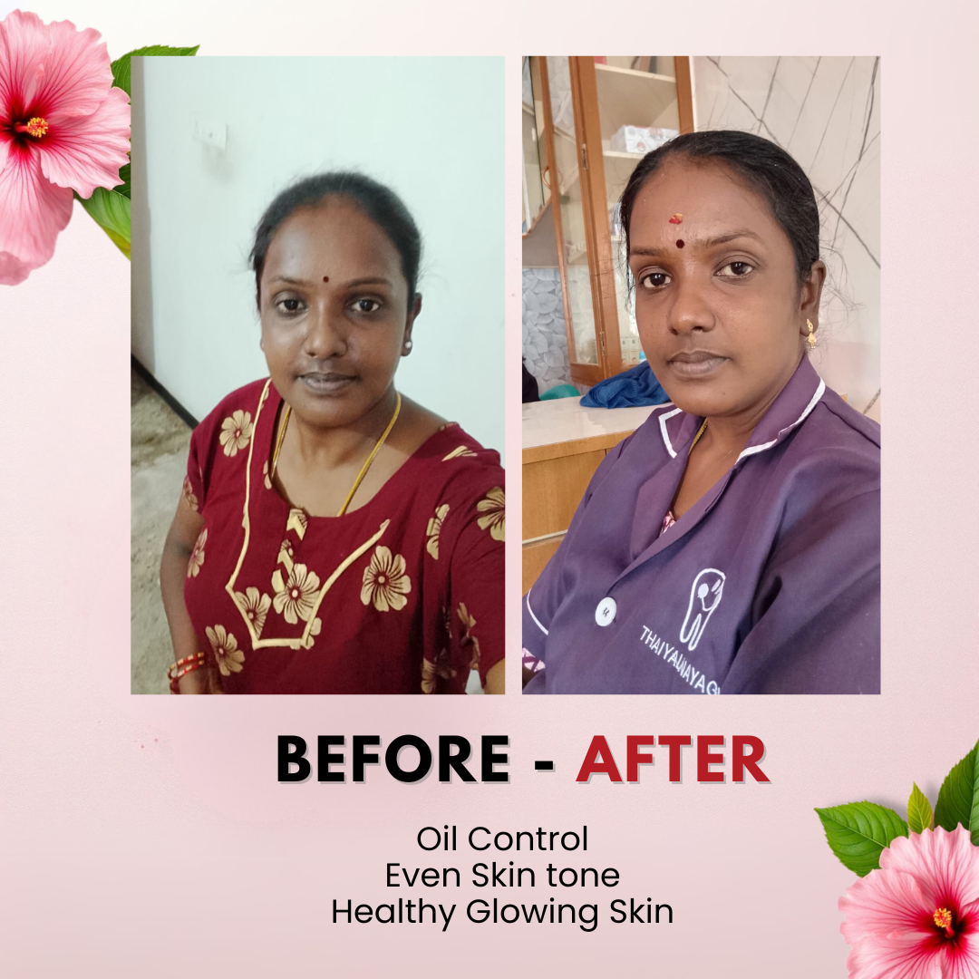Tvishi Clear Skin Bundle before and after results — reduced acne, blackheads and pigmentation