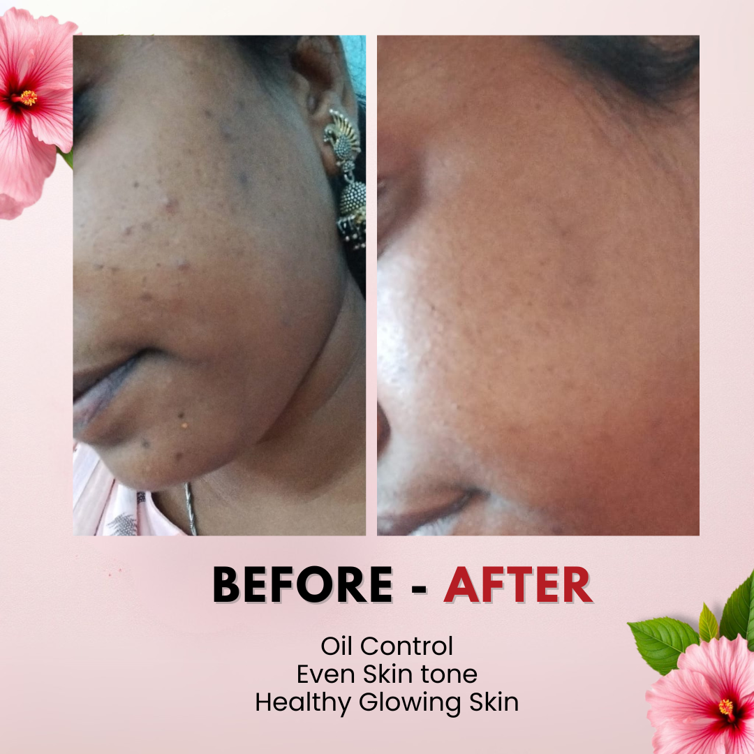 Tvishi Hydrate Skin Bundle before and after — reduced acne, pigmentation, blackheads and non-greasy feel