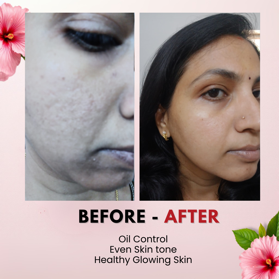 Tvishi Refresh Skin Bundle before and after — reduced acne, pigmentation, blackheads and long-lasting freshness